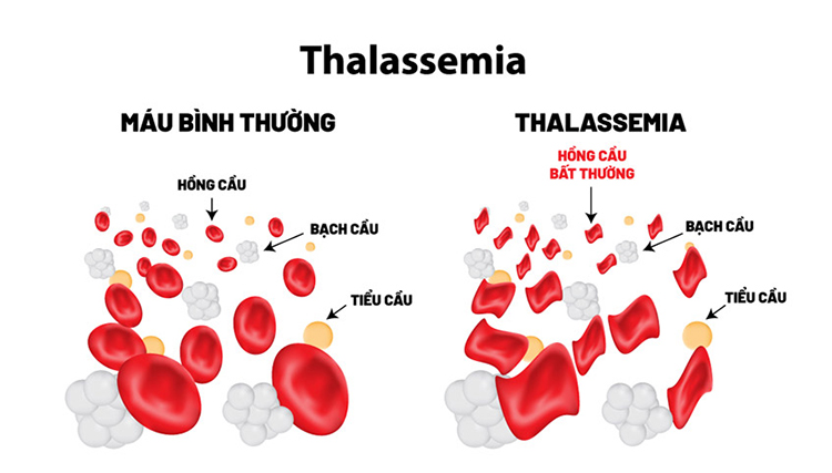 Thiếu máu thalassemia là gì? 1